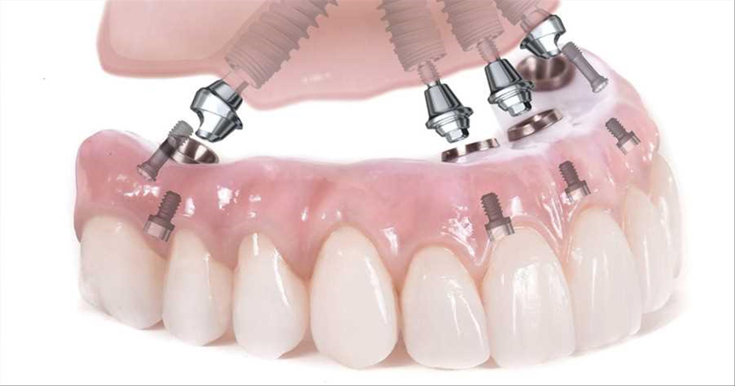 İmplant ,diş implantı